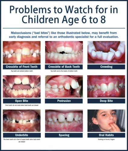 Indications for early or interventional orthodontic treatment in kids.