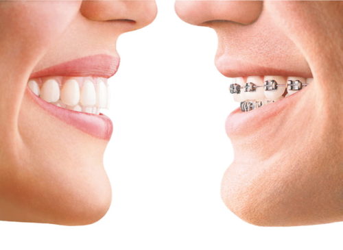 Compare Invisalign vs braces.